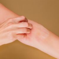 Woman,Scratching,Arm,With,Rash,And,Irritation