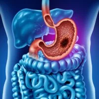Gastric,Cancer,Or,Stomach,Tumor,In,The,Digestive,System,As