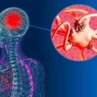 Brain,Cells,Affected,By,Alzheimer’s,Disease.,Dying,Brain,Neurons,In