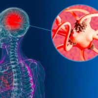 Brain,Cells,Affected,By,Alzheimer’s,Disease.,Dying,Brain,Neurons,In