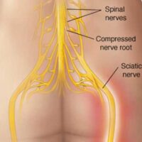 HHL_Dec11_Part03_04_Tested_Self-Help-Tips-for-Sciatica-728×381