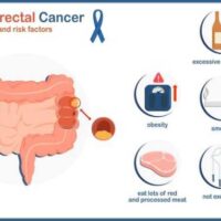 colorectal-cancer-728×382