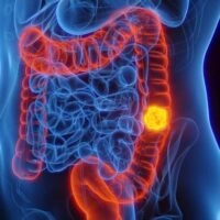 3d,Rendered,Medical,Illustration,Of,Male,Anatomy,-,Colon,Cancer;