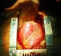 Feb05_Part04_02_heart-surgeon-348×182