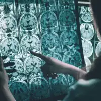 Alzheimer&rsquo;s,Disease,On,Mri