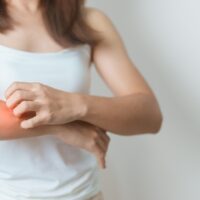 Woman,Itching,And,Scratching,Itchy,Arm.,Sensitive,Skin,Allergic,Reaction
